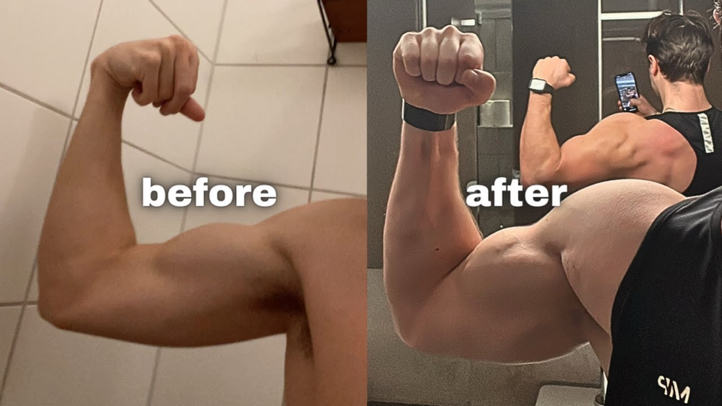 Can You Fix or Reduce the Appearance of a Bicep Gap?