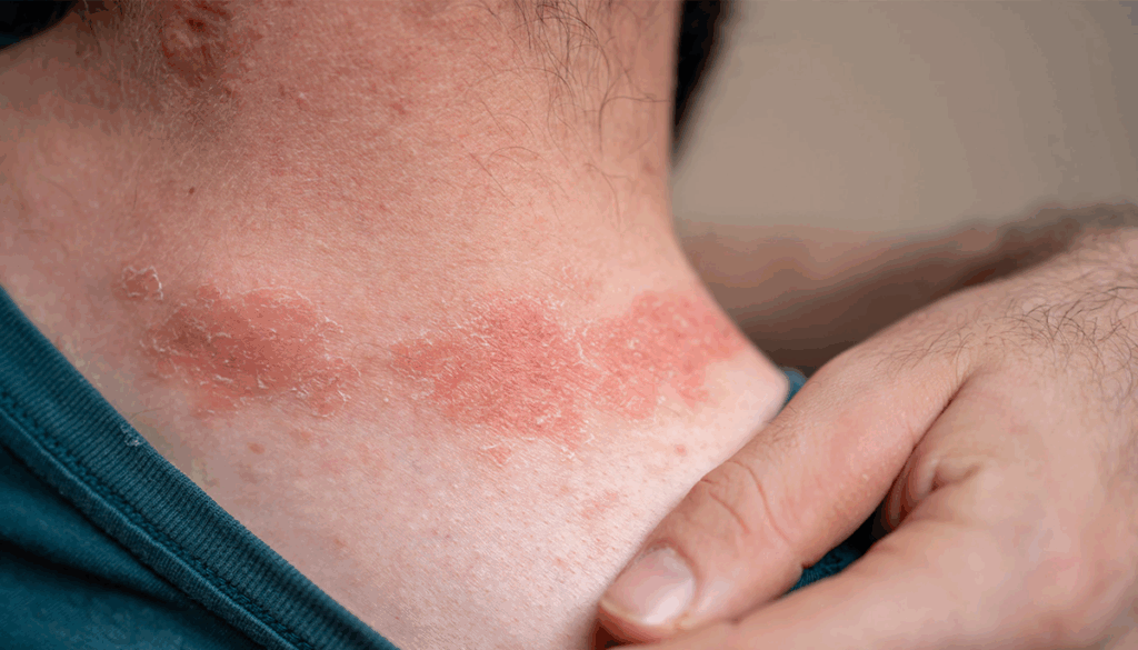 Betamethasone dipropionate skin infections